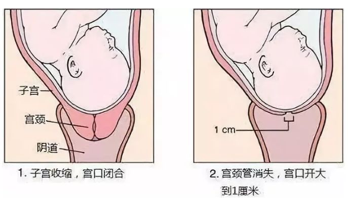 初产妇多是宫颈管先消失,宫口后扩张;经产妇多是颈管消失与宫口扩张