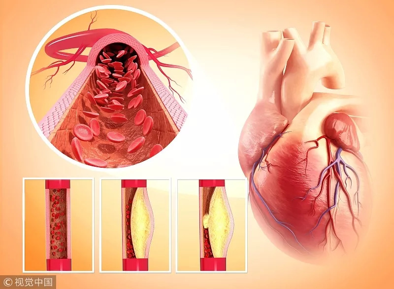 我们遇到的最常见的心脏病 一般就是冠心病 全称是:冠状动脉性心脏病