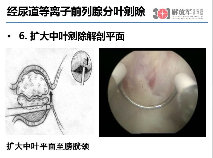 符伟军:经尿道等离子前列腺分叶剜除术