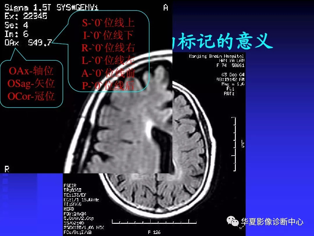 【基础必备】头颅mri读片知识