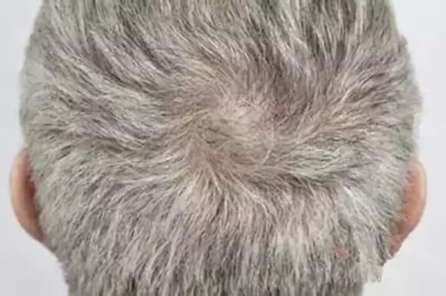 养发馆资讯:头顶,后脑勺白发是什么原因?