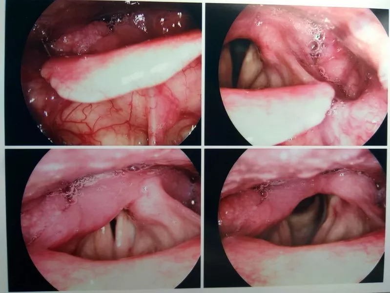 病例3患者病变位于右侧梨状窝的内侧壁,双侧声带活动未受限.