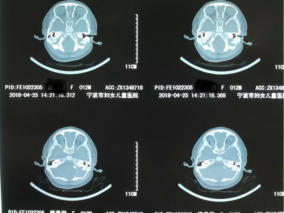 随后赴医院拍摄颞骨hr-ct,医院提示中耳畸形听骨链异常 气