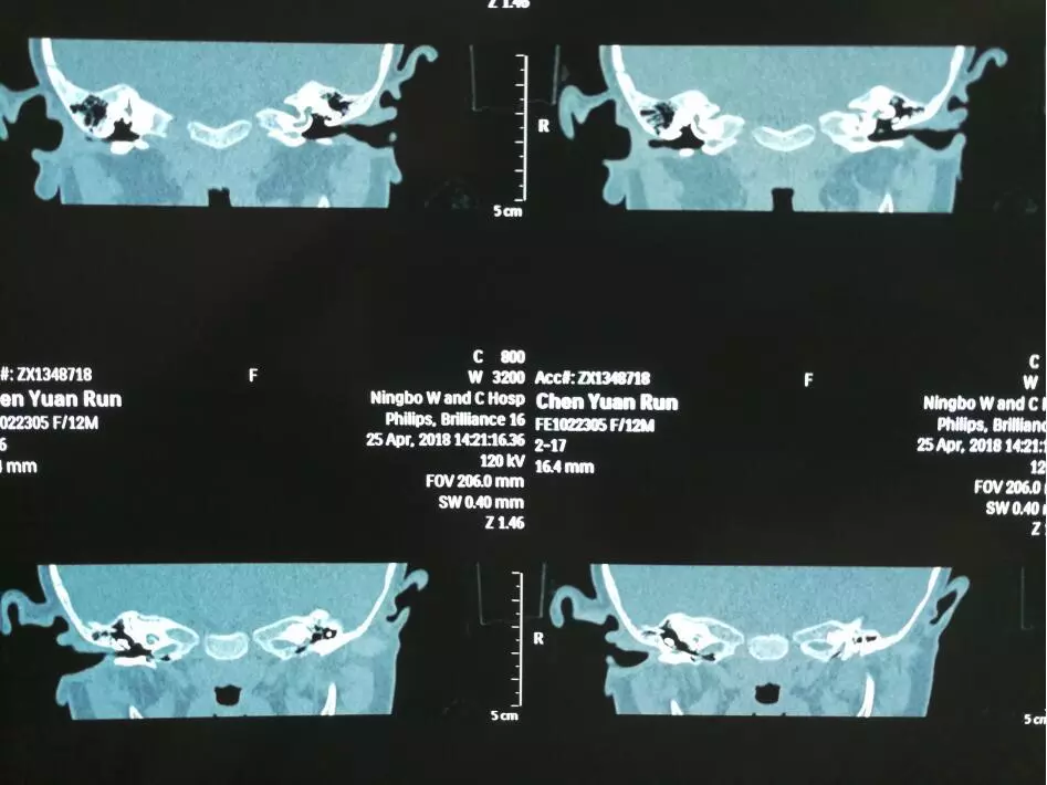 随后赴医院拍摄颞骨hr-ct,医院提示中耳畸形听骨链异常 气