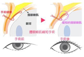 是通过手术将单睑的解剖结构进行修改重组最后成形为重睑睁眼的时候不