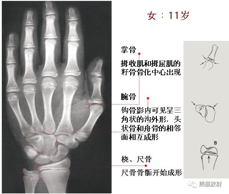 这些男,女性骨龄图谱,你都掌握了吗?