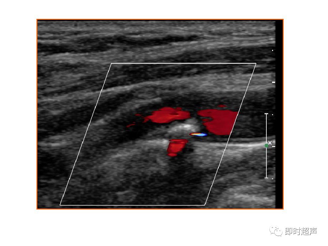 颈部血管超声正常解剖及常见病的超声诊断标准