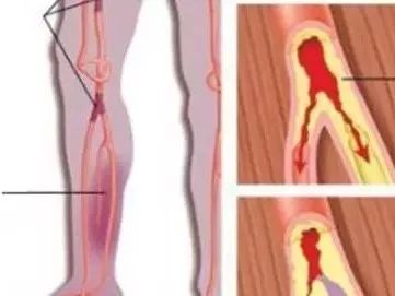 有血栓的人口比例_腿上有血栓真人图片