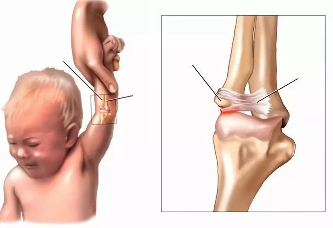 而小儿桡骨小头的环状韧带并未发育完全,肘关节相对薄弱和松弛,所以当