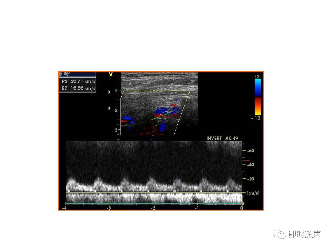 颈部血管超声正常解剖及常见病的超声诊断标准