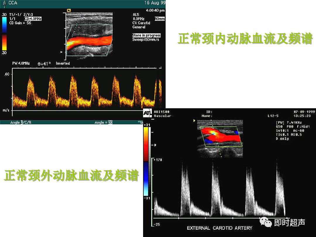 颈部血管超声正常解剖及常见病的超声诊断标准