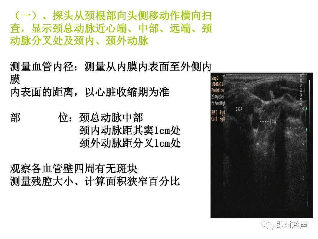 颈部血管超声正常解剖及常见病的超声诊断标准