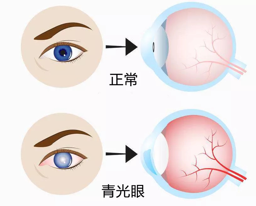 警惕视力的小偷——青光眼