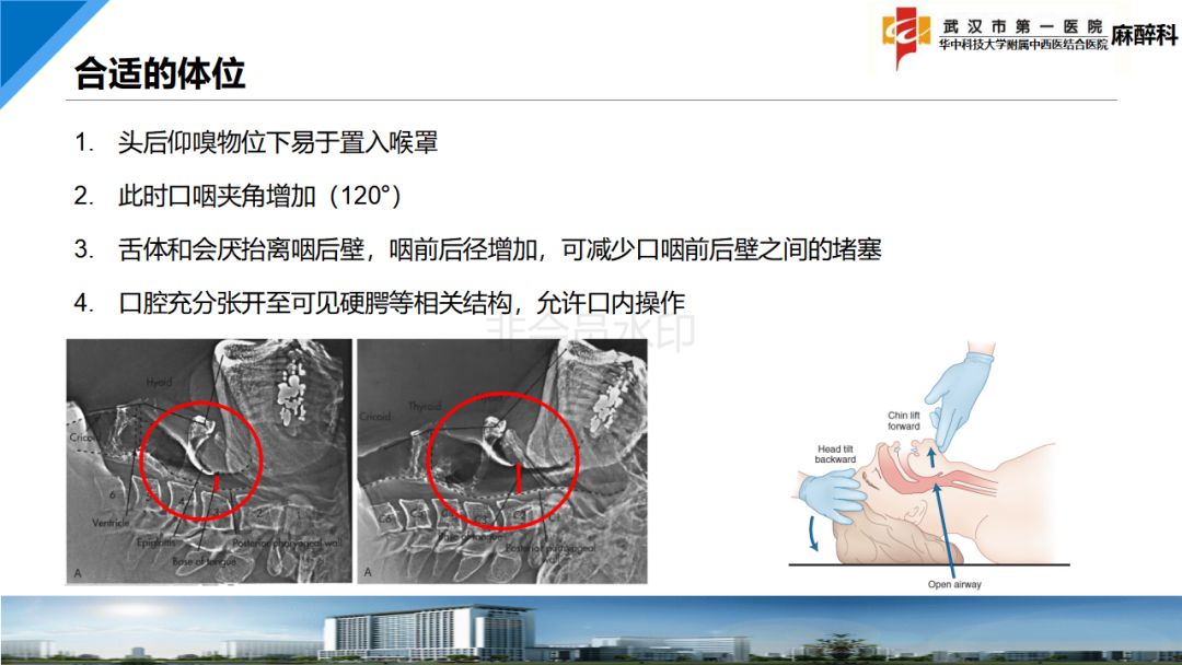 麻醉讲堂经典喉罩置入技术