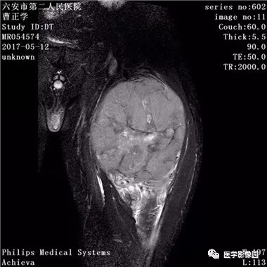 横纹肌肉瘤等你分析读片专栏879期