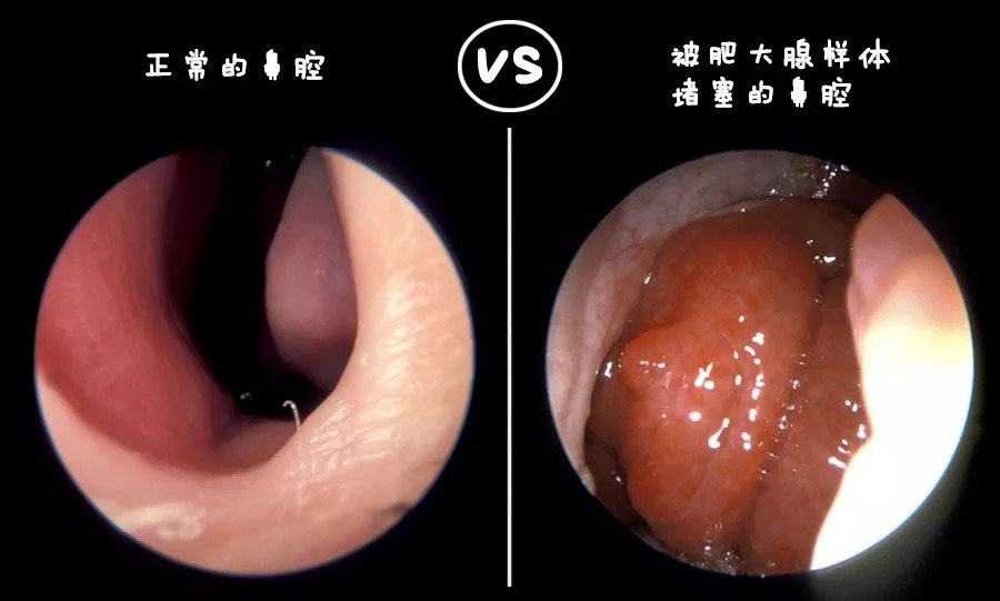 腺样体出了毛病,耳鼻喉部位也跟着遭殃(譬如堵住鼻腔).▼