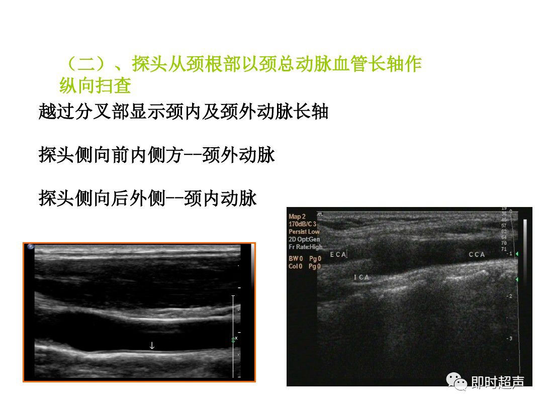 颈部血管超声正常解剖及常见病的超声诊断标准