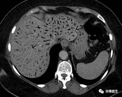 肝门静脉积气ct:沿着门脉走行的枯枝样低密度影