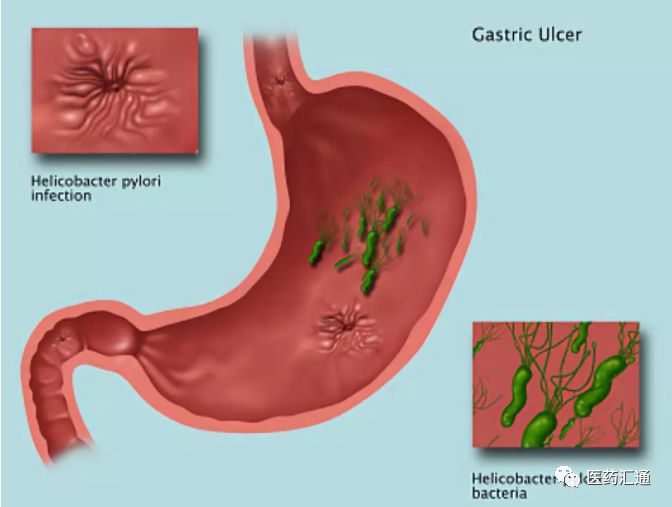 幽门螺旋杆菌难防,难治,易复发?看完这篇文,预防治疗两不误