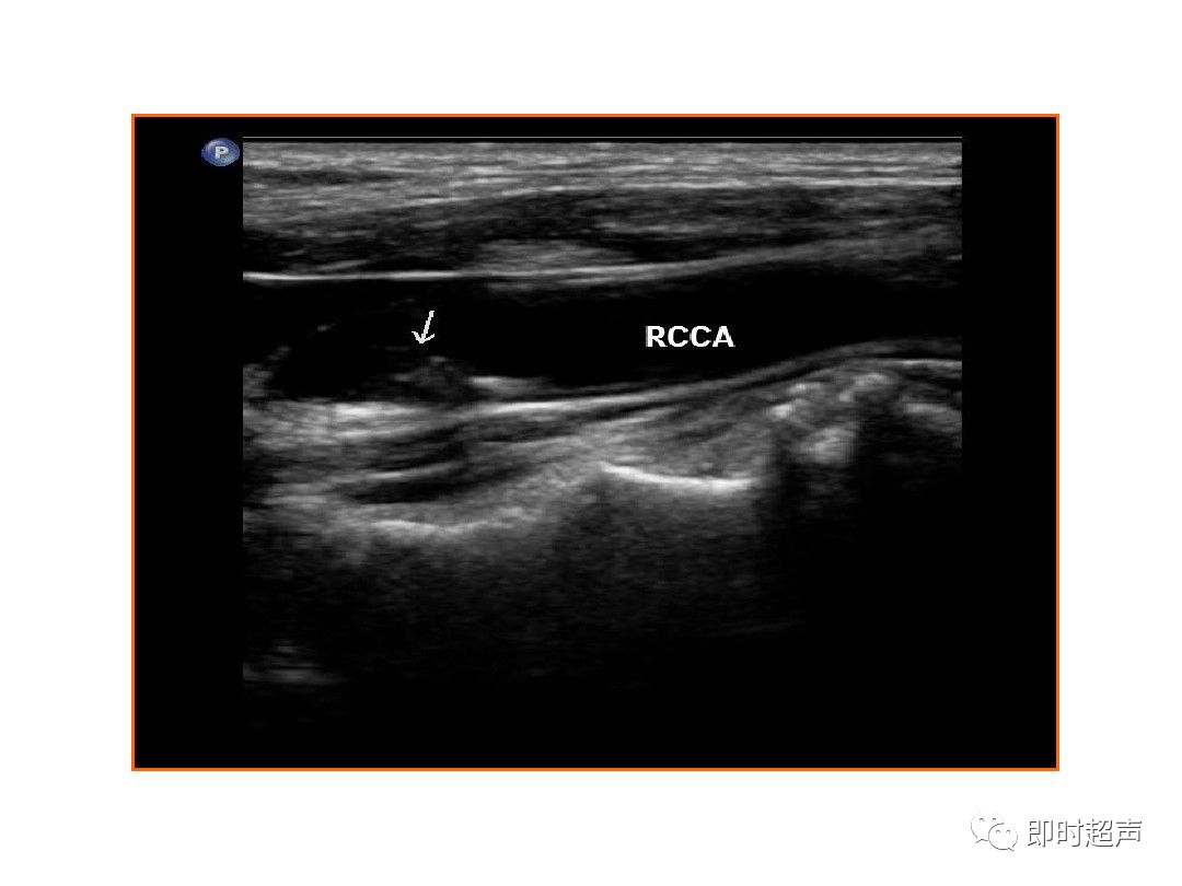 颈部血管超声正常解剖及常见病的超声诊断标准