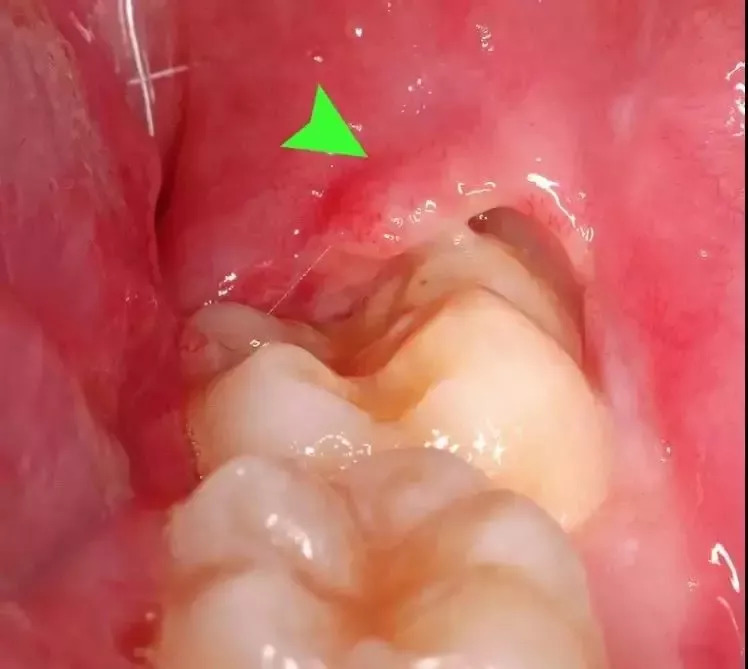 智齿反复发炎捅破脸智牙到底要不要拔