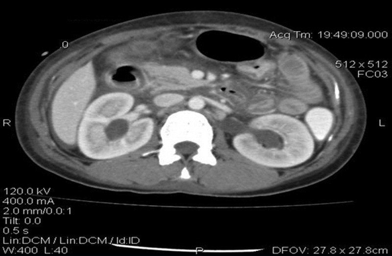 腹部增强ct显示双侧肾积水
