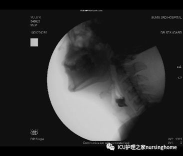 吞咽障碍如何做好康复护理?