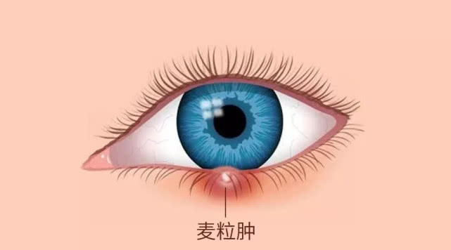 感觉要起针眼了怎么办