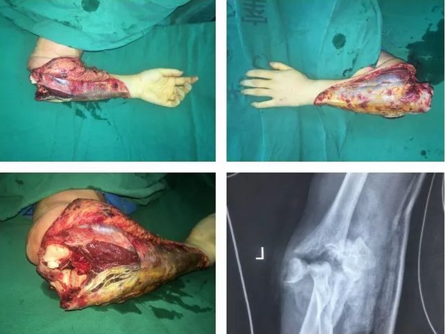 2018年8月20日,骨创伤二科又接急诊一例左上肢车祸碾压伤患者,患者贺