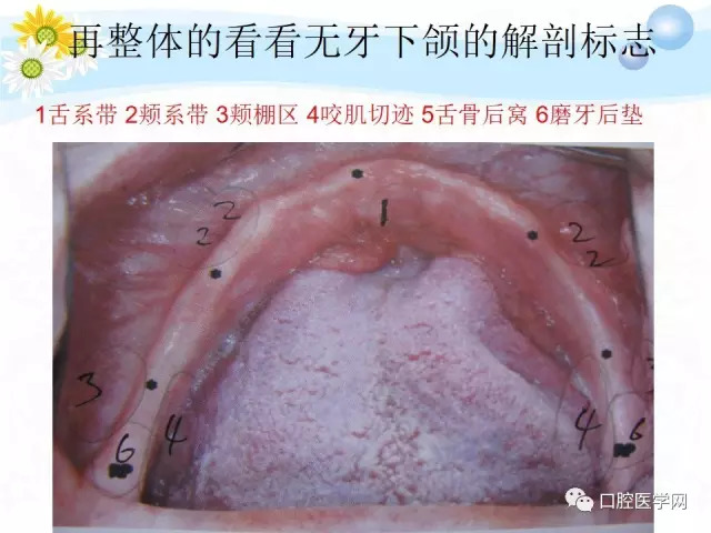 图上下无牙颌解剖标志