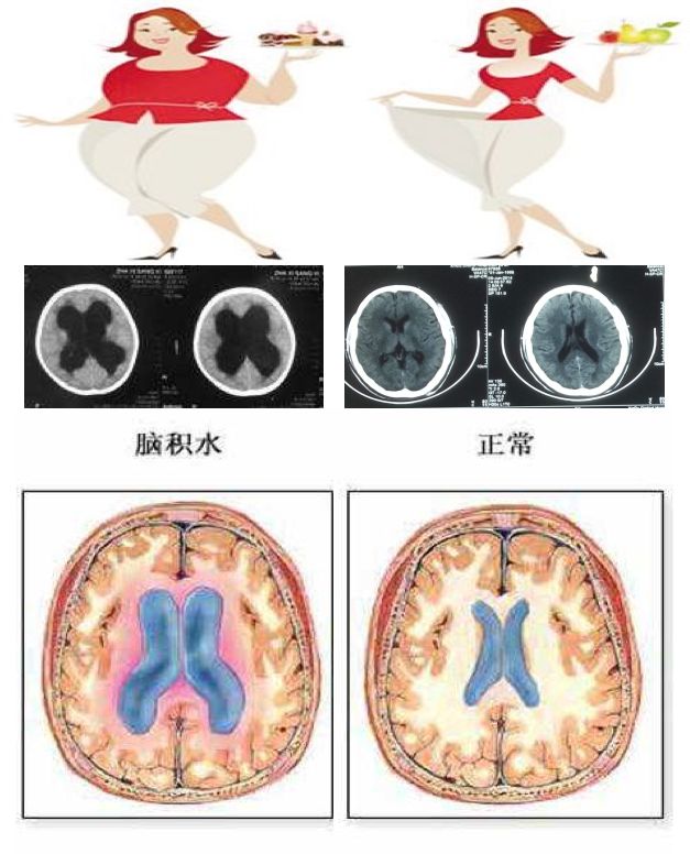 大头儿子其实是小儿先天性脑积水患者