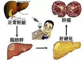 【涨涨健识】从"脂肪肝"到"肝癌"只有四步,你的肝脏该