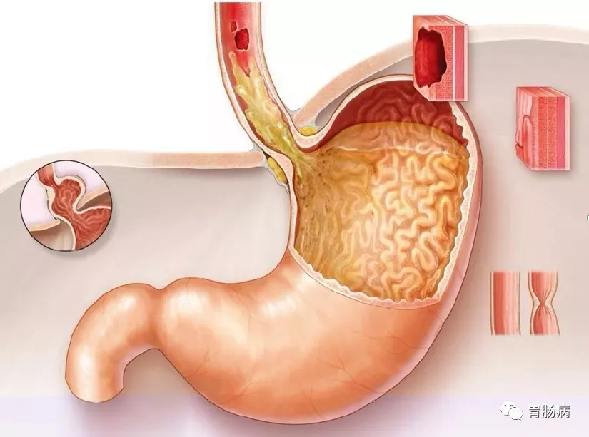 如何诊断胃食管反流病?_症状