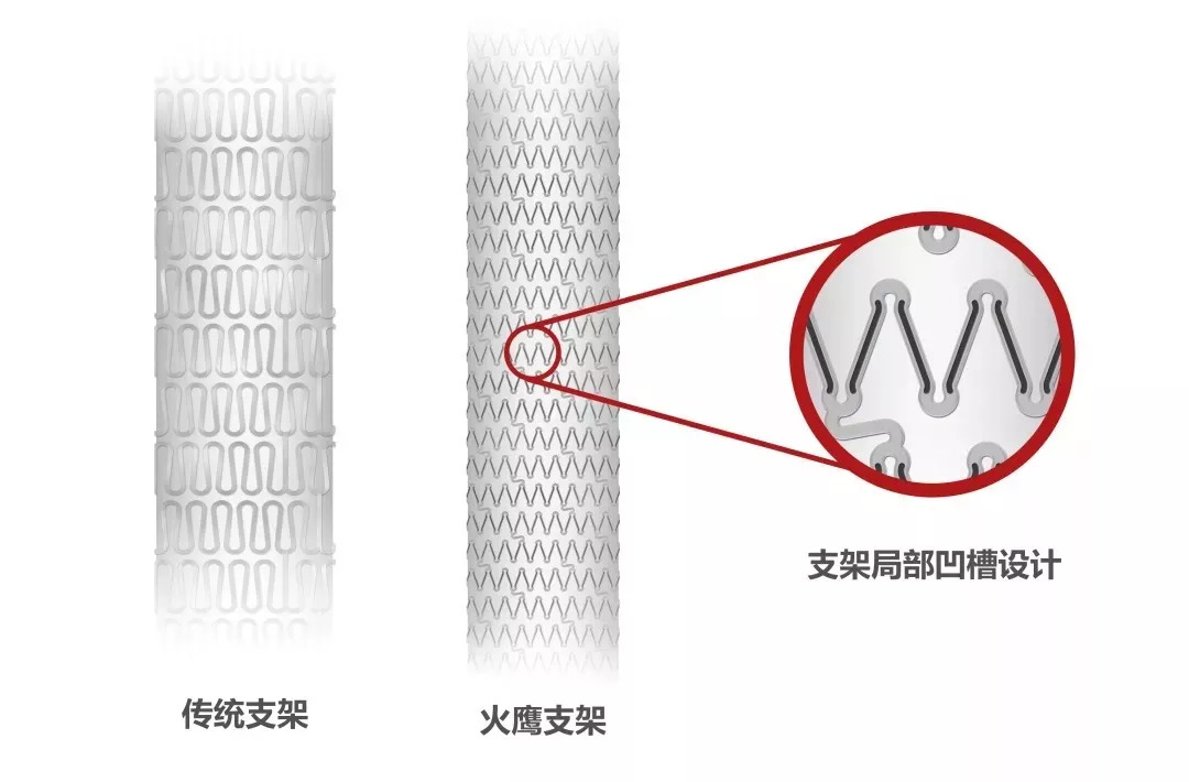 集团资讯重磅顶级权威医学杂志柳叶刀发布微创03火鹰03支架欧洲大