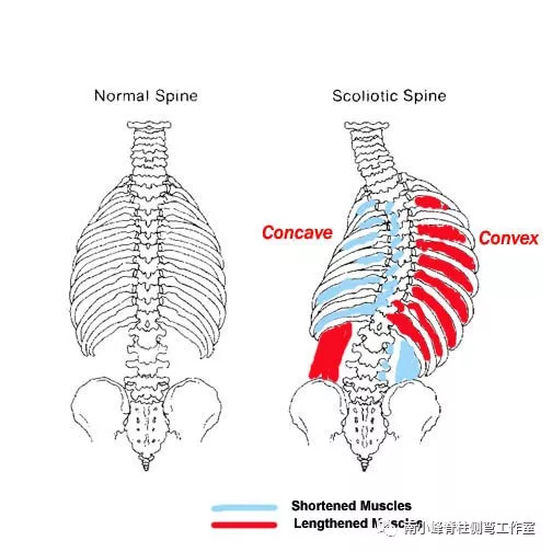 对于胸廓来说,凸侧的肋骨张开很大,凹侧的肋骨间隙变窄. 责任编辑