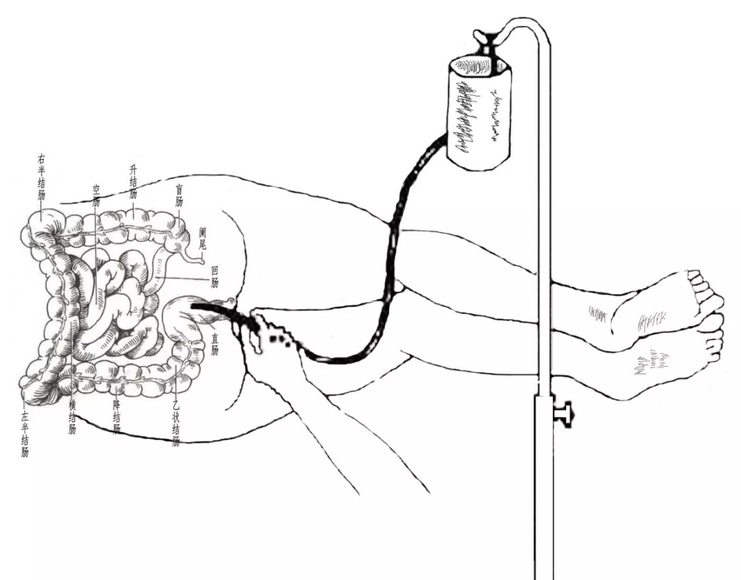 【基层中医适宜技术】肛肠类—中药灌肠技术