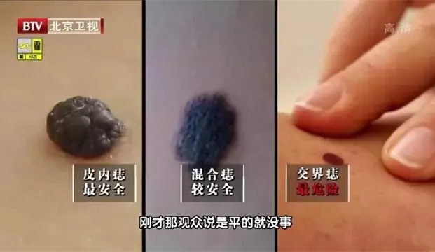 良性痣→原发性黑色素瘤→转移性黑色素瘤 从病理学角度,痣可以分为皮