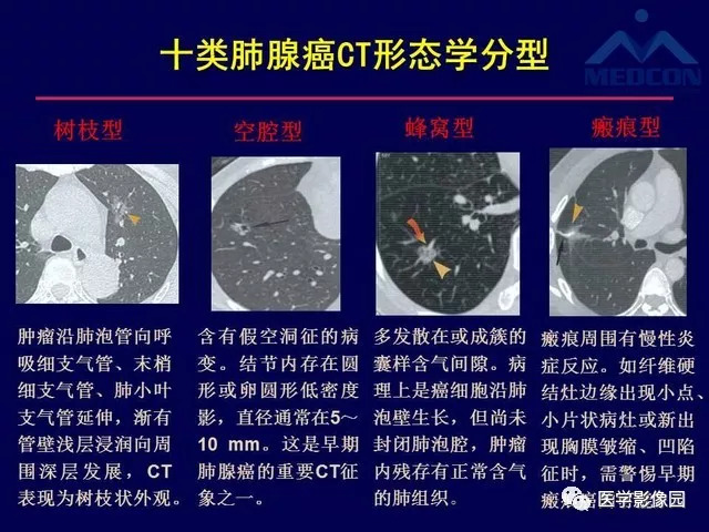 肺癌的ct影像学特征及临床意义影像天地