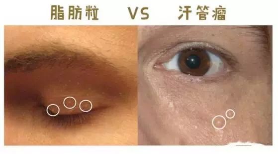 汗管瘤和脂肪粒的区别  vs  脂肪粒