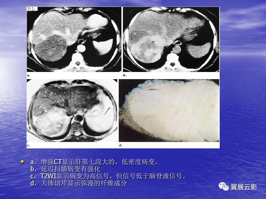 不典型肝血管瘤的影像学表现