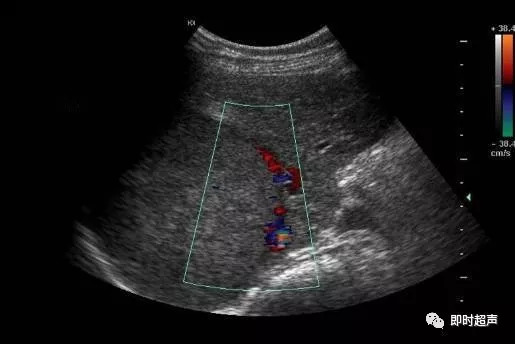 肝脏超声检查你应该知道这些来源:超声诊断学 版权声明:本文为公益性