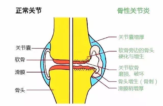 风湿人口_风湿疙瘩图片