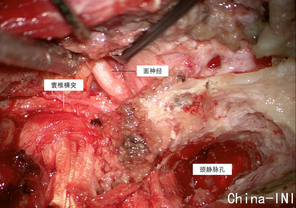 正海妙术视界宣武神外dias精致学手术系列之001颈静脉孔区神经鞘瘤