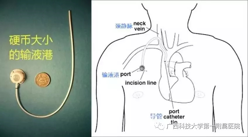 敲黑板对于植入式静脉输液港你知道多少