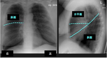 ②右肺有三叶(上叶,中叶,下叶),由水平裂和斜裂分隔.