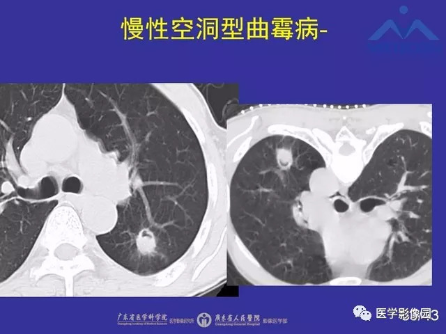 肺曲霉菌病的空气新月征ct诊断要素影像天地