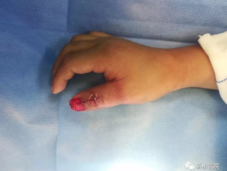 12岁女孩拇指畸形像"y" 医生妙手完美"并指"