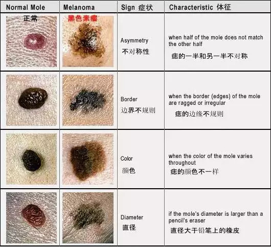 直接激光点掉可不可以?_皮内痣