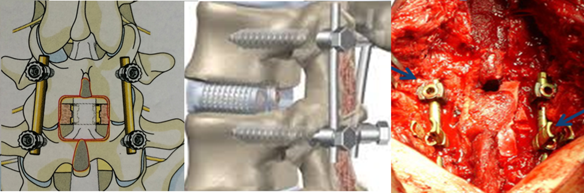 腰椎间盘突出植骨融合术你了解多少?