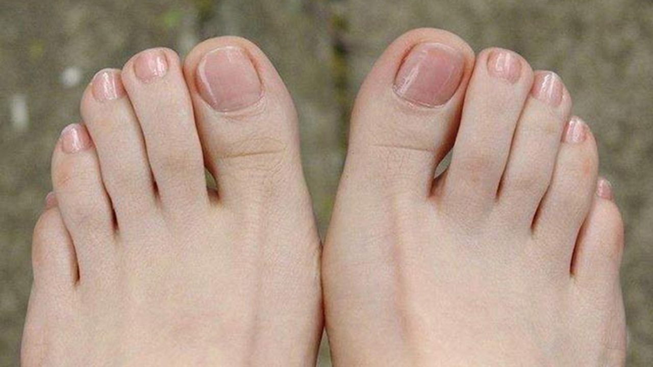 中国人的小脚趾,为什么都有两瓣指甲?真的代表血统纯正的汉人吗?